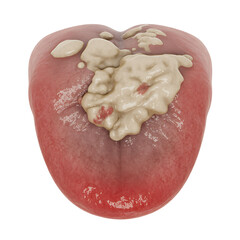 Human tongue with large white plaque and red inflamed areas with Transparent Background