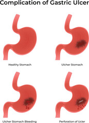 Complications and Progression of Gastric Ulcers diagram Vector illustration