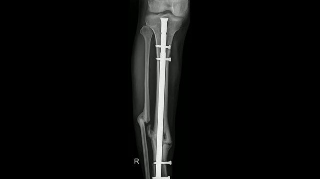 Post-operative X-ray of Right Tibia with Intramedullary Rod and Screw Fixation

