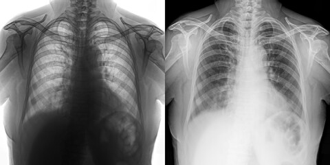 Chest Pa View X-Ray Radiograph Illustrating Lung Anatomy and Disease Indicators for Accurate Diagnosis of Pulmonary Anthrax Isolated on Transparent Background