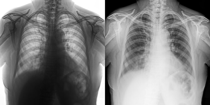 Chest Pa View X-Ray Radiograph Illustrating Lung Anatomy and Disease Indicators for Accurate Diagnosis of Pulmonary Anthrax Isolated on Transparent Background