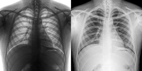 Chest Pa Projection X-Ray Radiograph Displaying Lung and Mediastinal Anatomy for Diagnostic Assessment of Pulmonary Anthrax Isolated on Transparent Background