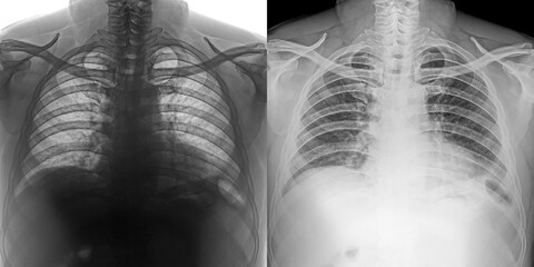Chest Pa View X-Ray Showing Detailed Lung Fields and Thoracic Anatomy for Detection and Diagnosis of Pulmonary Anthrax Isolated on Transparent Background