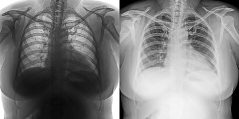 Chest Pa Projection X-Ray Radiograph Showing Lung Structure and Pathological Findings for Evaluation of Pulmonary Anthrax Isolated on Transparent Background