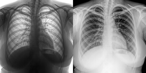 Chest X-Ray Radiograph Showing Pulmonary Structures and Mediastinal Anatomy for Detection and Diagnosis of Pulmonary Anthrax Isolated on Transparent Background