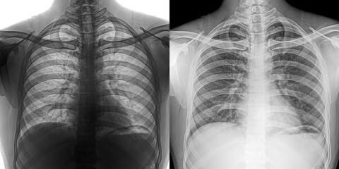Chest Pa View X-Ray Image Displaying Lung Fields and Thoracic Details for Clinical Evaluation of Pulmonary Anthrax Isolated on Transparent Background