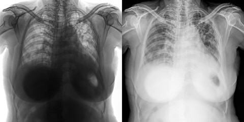 Chest Pa View X-Ray Showing Lung Fields and Disease Manifestations Related to Pulmonary Anthrax Isolated on Transparent Background for Radiological Illustration