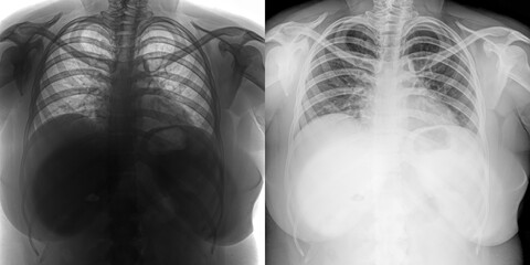 Chest Posteroanterior X-Ray Radiograph Demonstrating Pulmonary Anatomy for Diagnosis and Study of Pulmonary Anthrax Isolated on Transparent Background