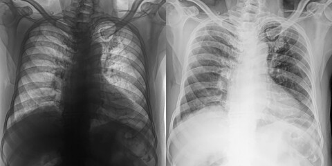 Chest Pa Projection X-Ray Radiograph Showing Lung Anatomy and Pathological Changes for Diagnosis of Pulmonary Anthrax Isolated on Transparent Background