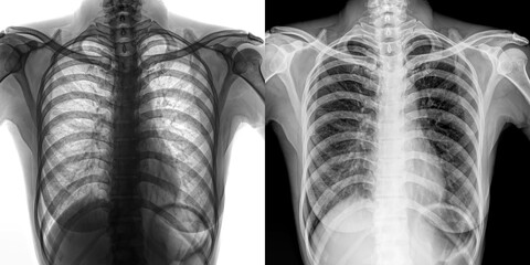 Chest Pa View Radiograph Displaying Lung Fields and Thoracic Cavity for Detection and Evaluation of Pulmonary Anthrax Isolated on Transparent Background