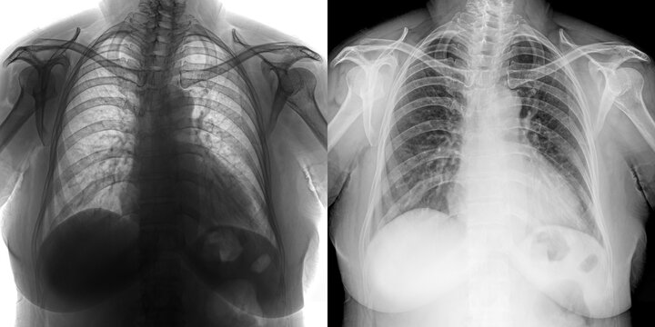 Chest Posteroanterior View X-Ray Showing Pulmonary Structure and Infection Indicators for Pulmonary Anthrax Diagnosis Isolated on Transparent Background
