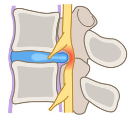 腰椎椎間板ヘルニア　椎間板の構造　腰痛