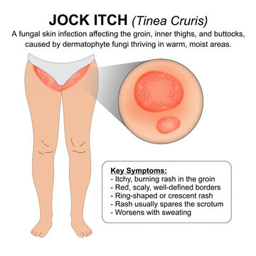 Jock Itch (Tinea Cruris) Medical Skin Flashcard