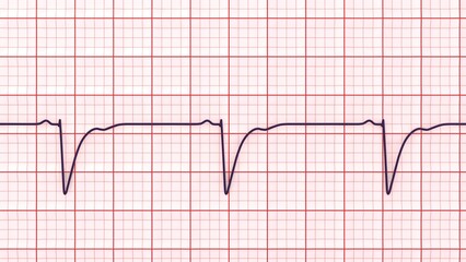 Naklejka premium Left ventricular hypertrophy, 3D illustration showing ECG leads V1-V2 with deep S waves and strain-related ST-T changes.