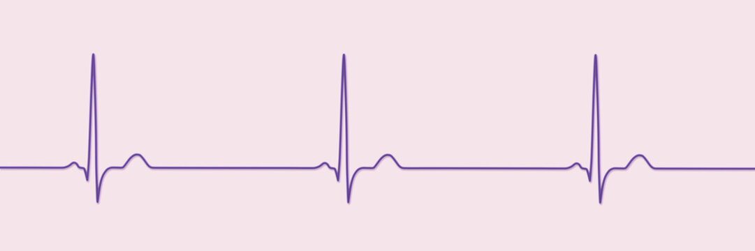 Sinus bradycardia, 3D illustration