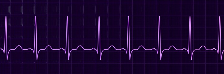 Sinus tachycardia, 3D illustration showing sinus rhythm with shortened RR intervals and increased heart rate.