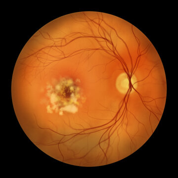 Best disease stage 4, illustration