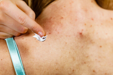 Woman with pimple on back applying medical ointmeny
