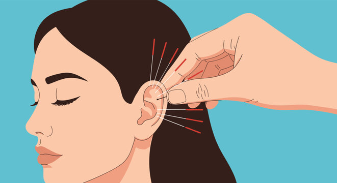 Close-up of a woman's ear receiving an auricular acupuncture treatment, with a hand carefully placing needles into specific points.