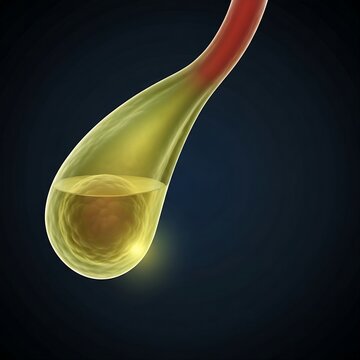 Cholecystitis with Empyema (Pus): An inflamed gallbladder containing a heavy, opaque, yellow-green internal fluid (pus), visibly stretching the walls. Hot-spot illumination on the infection. Dark blue