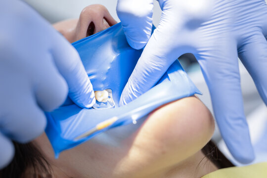 Close up rubber dam isolation and clamp during pediatric cavity filling procedure