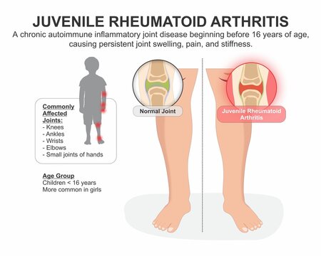 Juvenile Rheumatoid Arthritis (JRA/JIA)