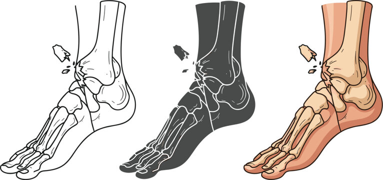 Illustration of a foot with a broken bone isolated on white background the image shows the bones of the foot and ankle, with a fracture in the talus bone