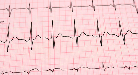 Close-up of an electrocardiogram (ECG) printout showing heart activity