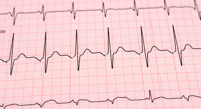 Close-up of an electrocardiogram (ECG) printout showing heart activity