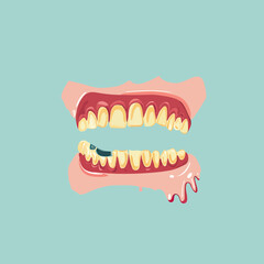 Flat minimalist vector illustration of unhealthy yellow teeth with periodontitis and bleeding gums dental disease concept with black cavity tooth and gum inflammation on teal background