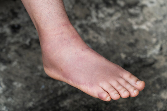 Swollen Foot After Cast Removal of Metatarsal Fracture
