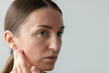 Woman with bruise near eye after beauty injections.