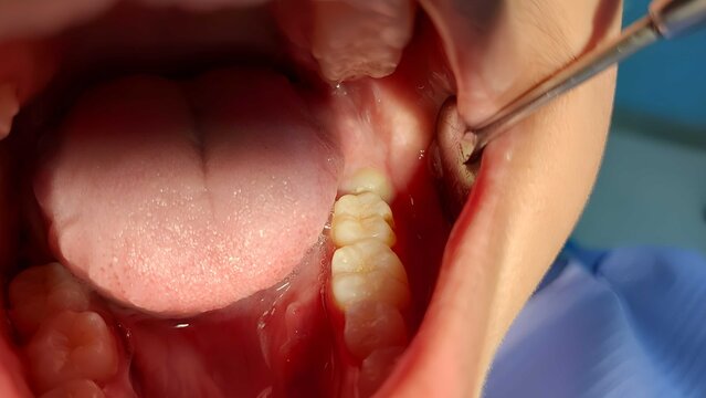 Close-up intraoral photograph showing an impacted tooth before extraction procedure, highlighting dental anatomy, oral surgery preparation, and clinical conditions in a medical setting.