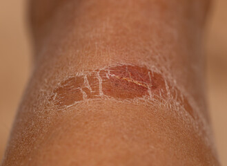 Fototapeta premium A person's arm has a scab on it