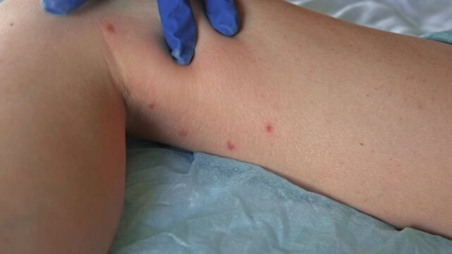 Doctor examining teen girl with bodily red rash. Allergy closeup. Teenager scratches eruption. Nurse applies special cream to atopic skin. Dermatitis, irritation, hive. Pruritus. Mosquito, flea bites