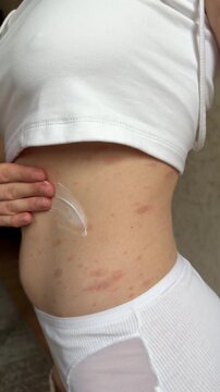 A girl applies cream to a rash on her stomach. Pityriasis rosea on a woman's stomach.
