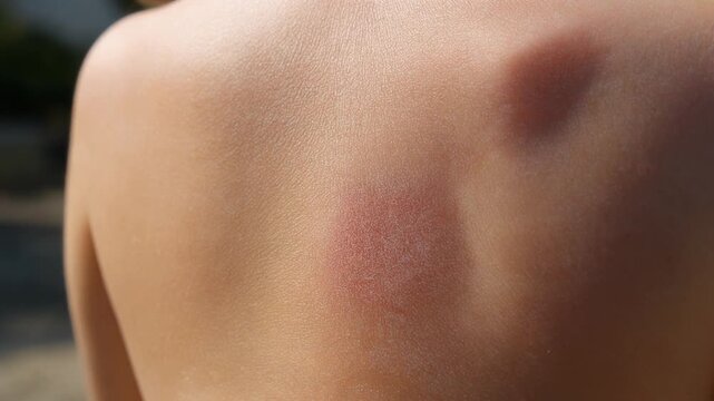 A close up of a person's back showing sunburn and skin irritation, a common summer issue sunburn, redness.