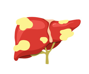Liver disease. Medical illustration of fatty liver anatomy. Disease treatment for cancer or hepatitis. Vector design.