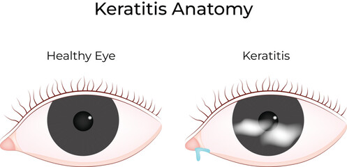 Keratitis Anatomy Healthy Eye vs Affected Eye Comparison Vector Illustration