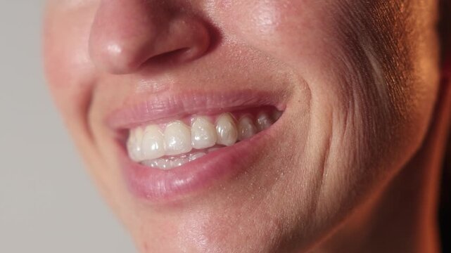 Woman uses dental trays for teeth whitening at home. Girl pours peroxide solution from syringe and applies on teeth, smiling to camera. Neutral background. Female holds trays in a purple case.