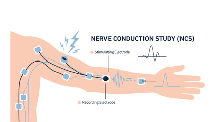 Obraz premium Nerve Conduction Study (NCS) Medical Procedure Infographic
