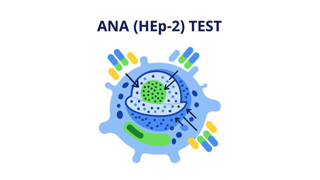 Medical illustration of ANA (HEp-2) test for autoimmune disease diagnosis. Vector style diagram showing a human epithelial cell with antibodies attacking the nucleus.