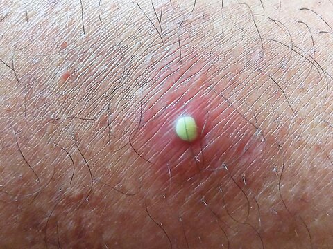 A close-up view of an inflamed pimple with visible pus on human skin, highlighting a minor skin infection or folliculitis.
