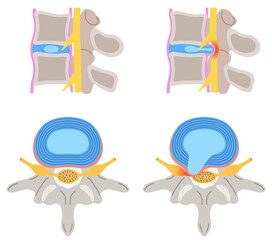 腰椎椎間板ヘルニア　椎間板の構造　腰痛