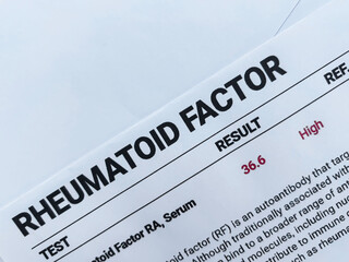 Rheumatoid factor test report showing high and abnormal value close up top view.