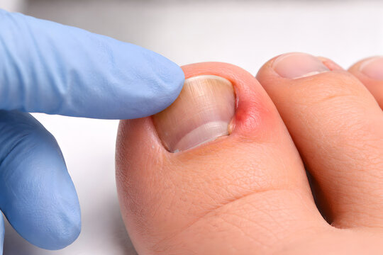 Photorealistic 3D macro close-up of an ingrown toenail on the big toe, nail edge curving into the lateral nail fold with mild swelling and redness, intact skin, ultra-detailed skin pores and cuticle t