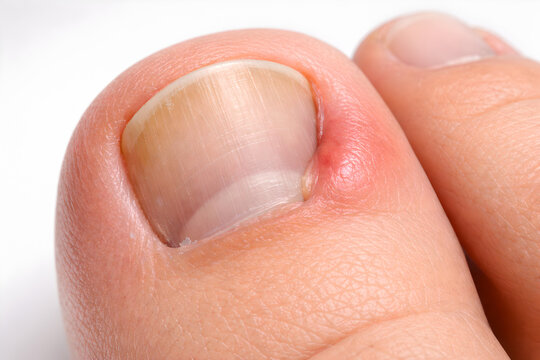 Photorealistic 3D macro close-up of an ingrown toenail on the big toe, nail edge curving into the lateral nail fold with mild swelling and redness, intact skin, ultra-detailed skin pores and cuticle t