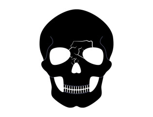 Nasal fracture poster