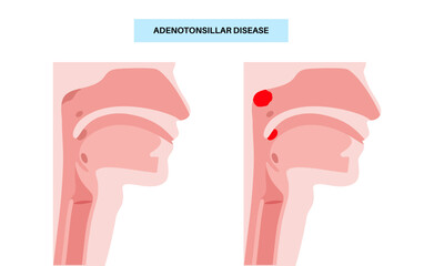 Adenotonsillar disease poster
