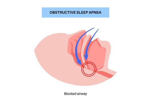 Obstructive sleep apnea